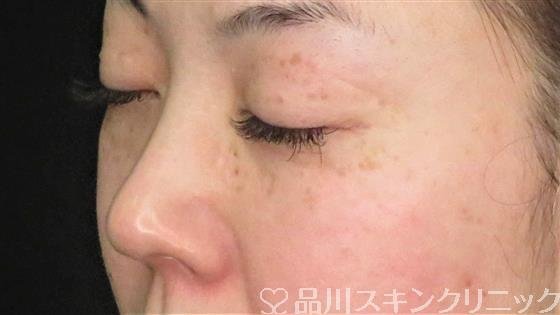 症例NO.61020のBEFORE写真