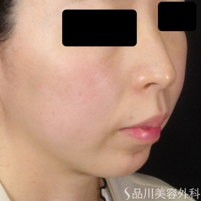 症例NO.71500のBEFORE写真