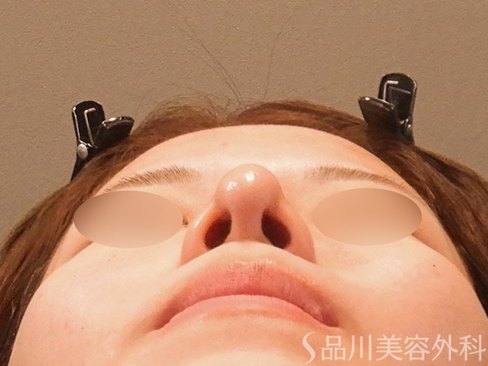 症例NO.67617のAFTER写真