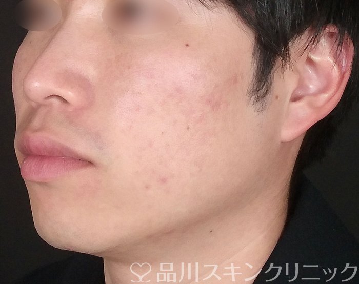 症例NO.68314のAFTER写真