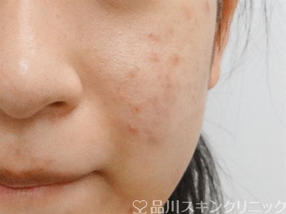 症例NO.32206のAFTER写真