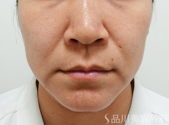 症例NO.72846のBEFORE写真