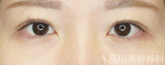 症例NO.69429のAFTER写真