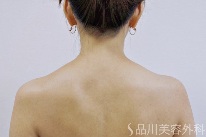 症例NO.73560のBEFORE写真