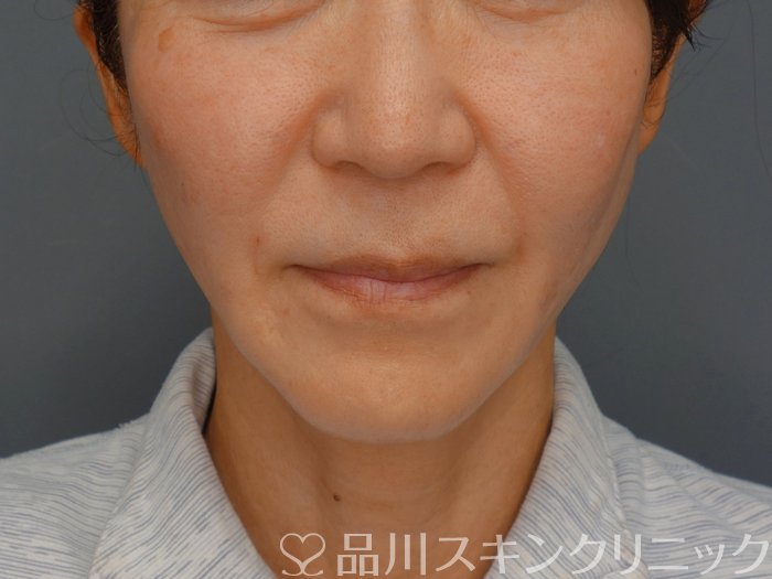 症例NO.74314のAFTER写真