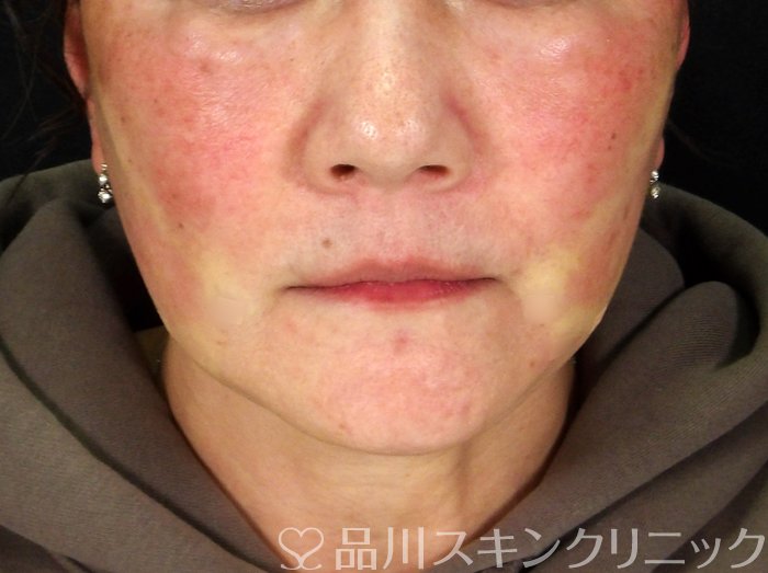 症例NO.72608のAFTER写真