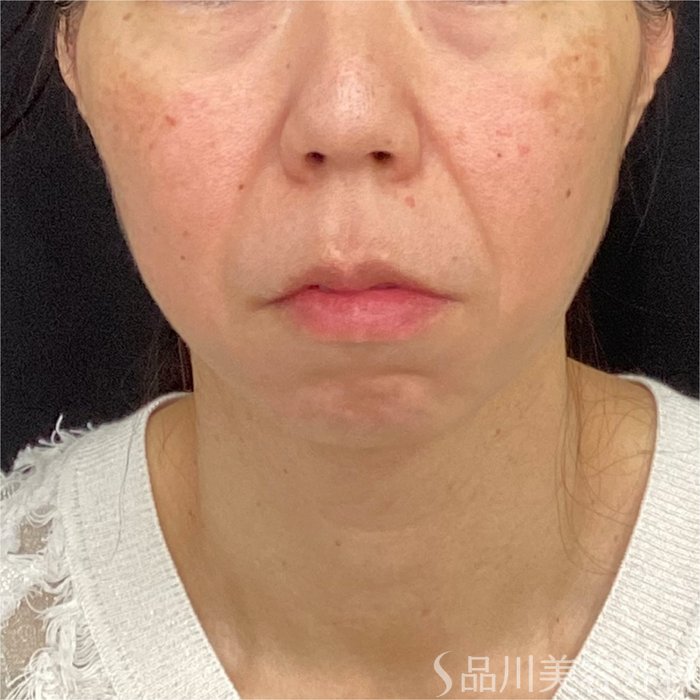 症例NO.70163のBEFORE写真