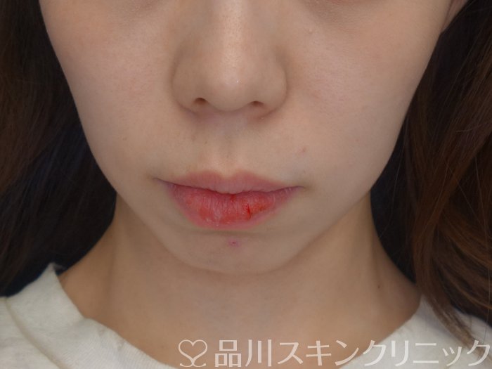 症例NO.74550のBEFORE写真