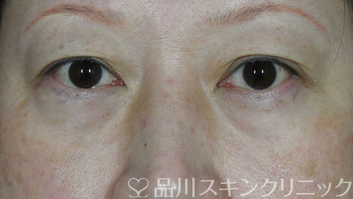 症例NO.72234のBEFORE写真