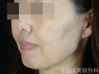 症例NO.74701のBEFORE写真