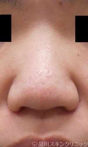症例NO.70208のBEFORE写真