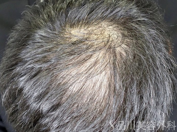 症例NO.72585のBEFORE写真