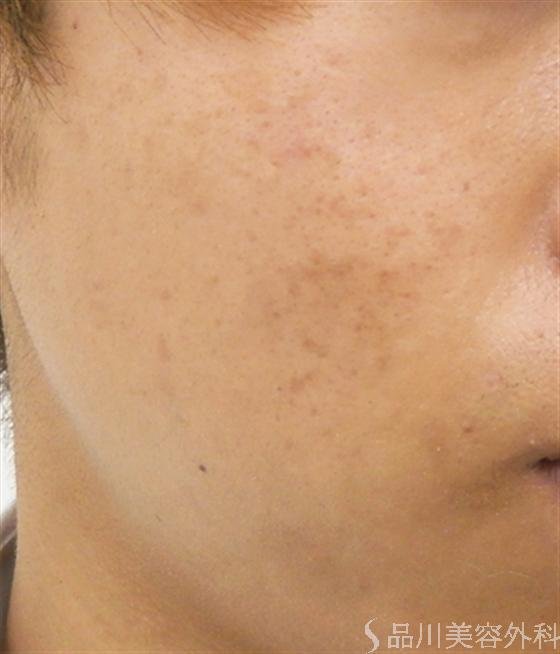 症例NO.18188のAFTER写真