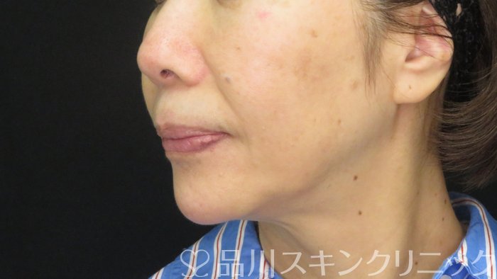 症例NO.72272のBEFORE写真