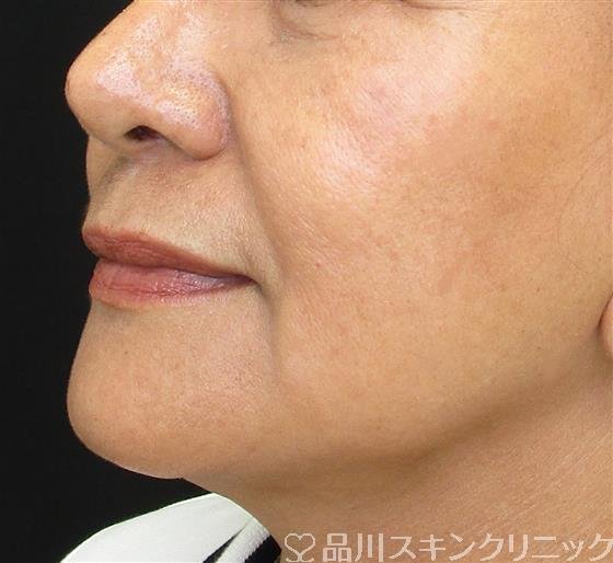 症例NO.56298のBEFORE写真