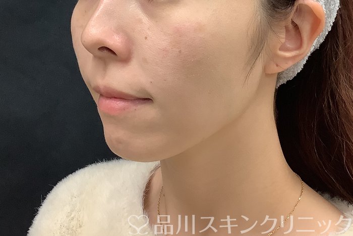 症例NO.69560のAFTER写真