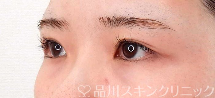 症例NO.63062のBEFORE写真