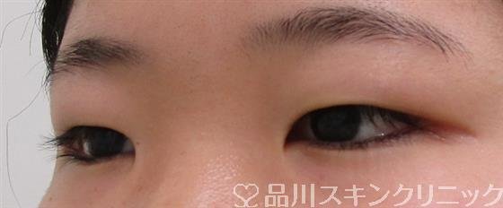 症例NO.41630のBEFORE写真