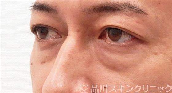 症例NO.61695のBEFORE写真