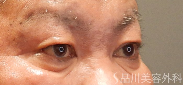 症例NO.69470のBEFORE写真