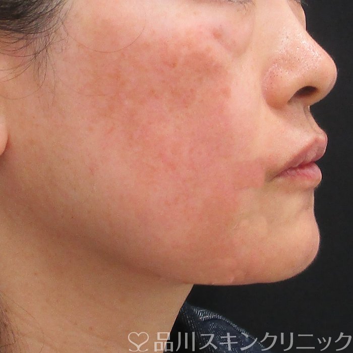 症例NO.75169のAFTER写真