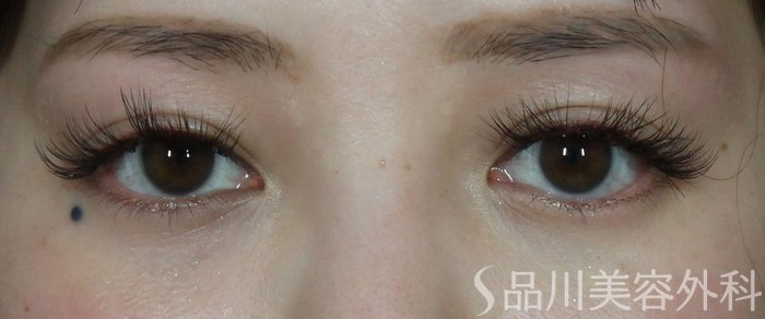 症例NO.73423のBEFORE写真