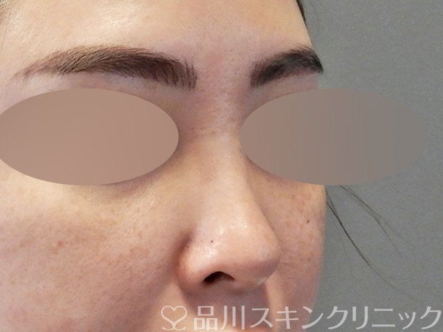 症例NO.67609のBEFORE写真