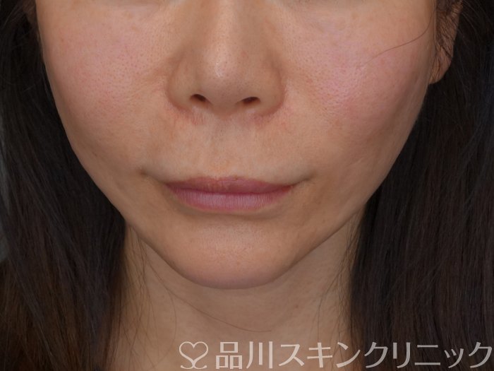 症例NO.74156のAFTER写真