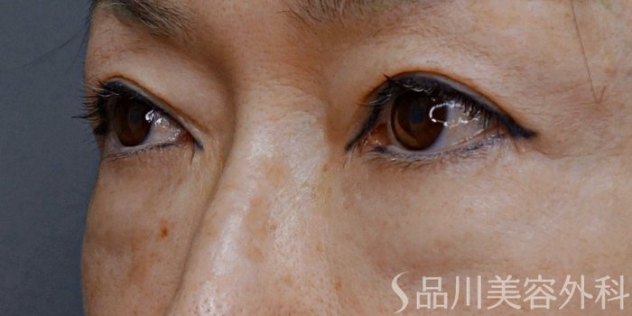 症例NO.74248のBEFORE写真