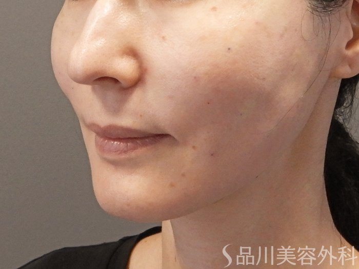 症例NO.71404のAFTER写真