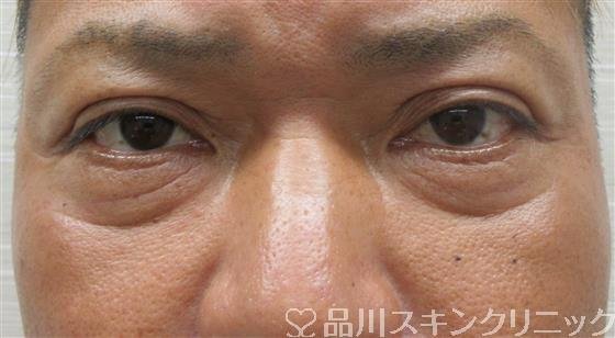 症例NO.57826のBEFORE写真