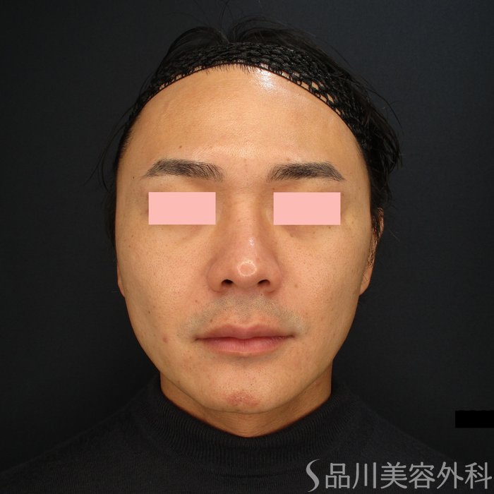 症例NO.69475のAFTER写真