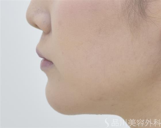 症例NO.44615のAFTER写真