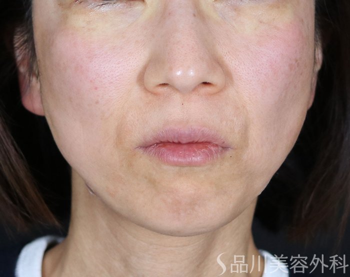 症例NO.73215のAFTER写真