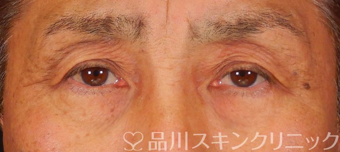 症例NO.66780のAFTER写真