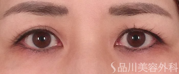 症例NO.70342のBEFORE写真