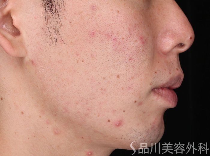 症例NO.72875のBEFORE写真