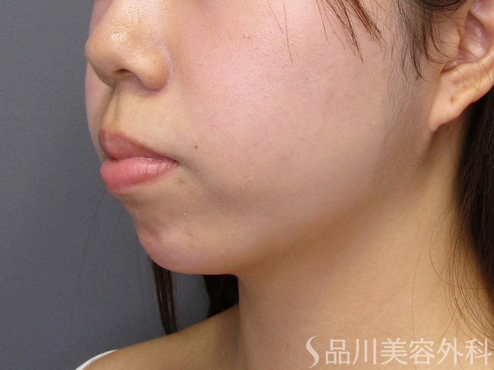 症例NO.75059のAFTER写真