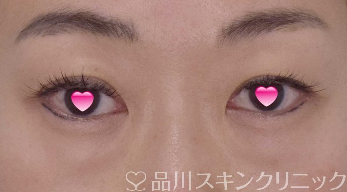 症例NO.65062のBEFORE写真