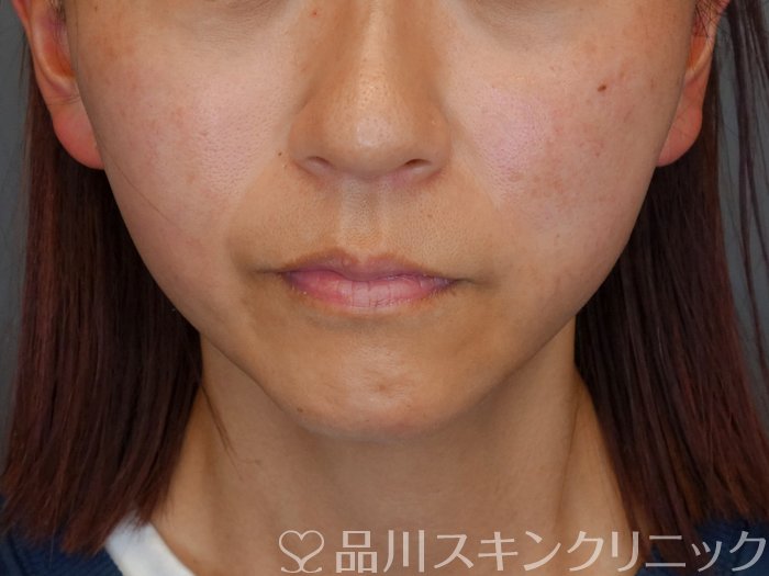 症例NO.72296のAFTER写真