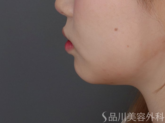 症例NO.71716のBEFORE写真