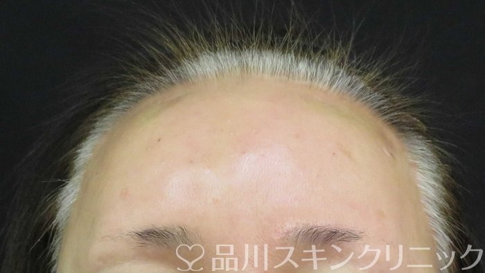 症例NO.74766のAFTER写真