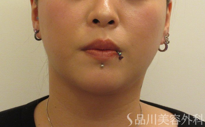 症例NO.71806のBEFORE写真