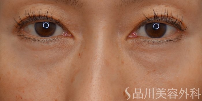 症例NO.62280のBEFORE写真