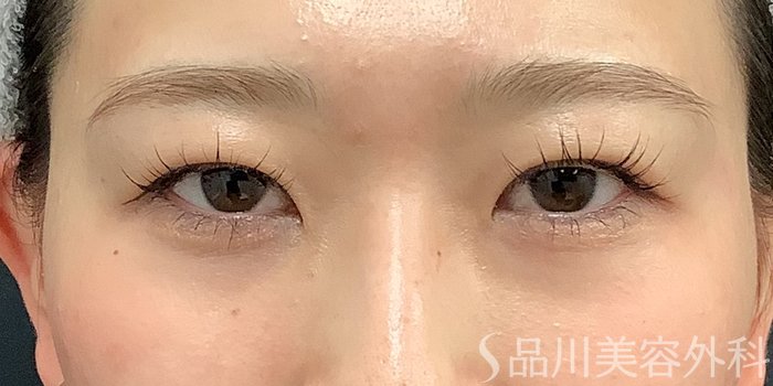 症例NO.71231のAFTER写真