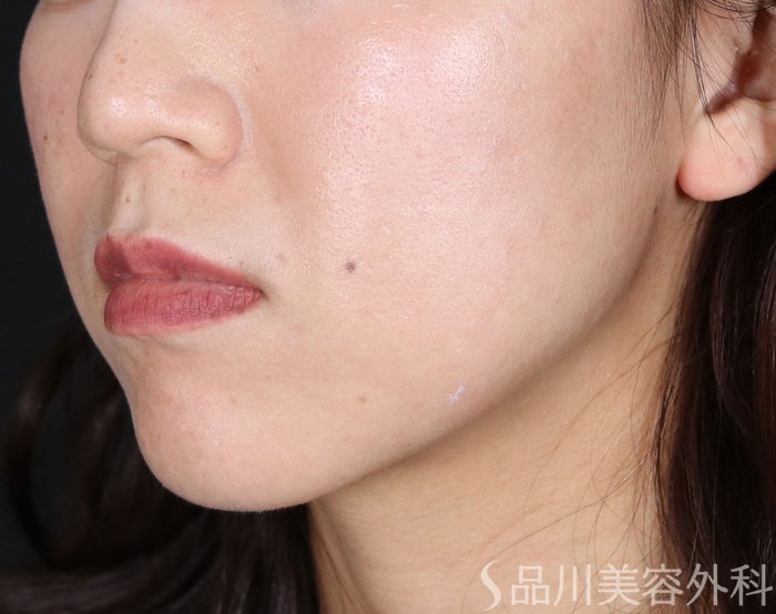 症例NO.72086のAFTER写真