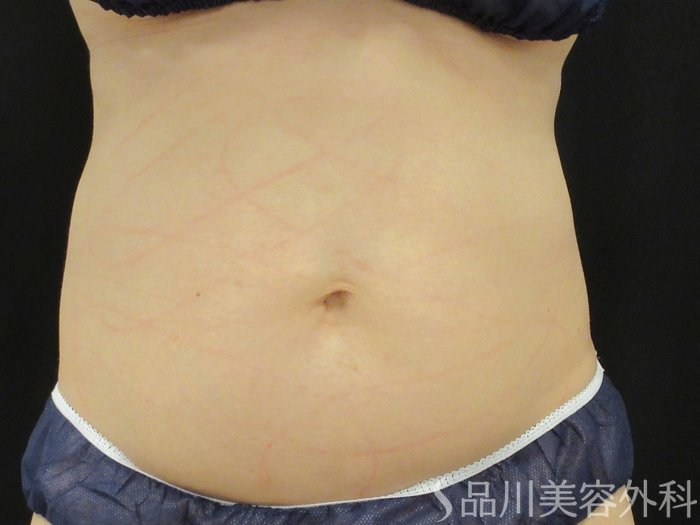 症例NO.75330のBEFORE写真
