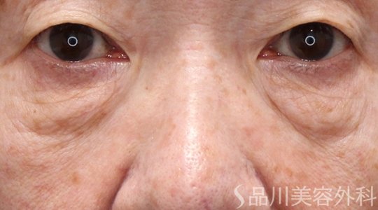 症例NO.71782のBEFORE写真