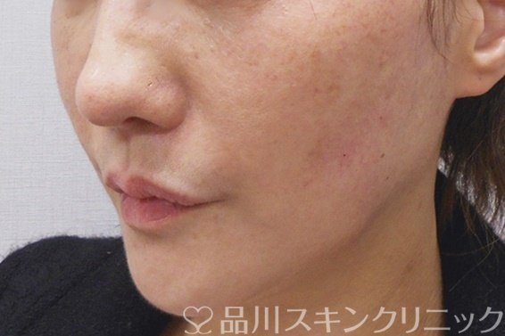 症例NO.69671のAFTER写真