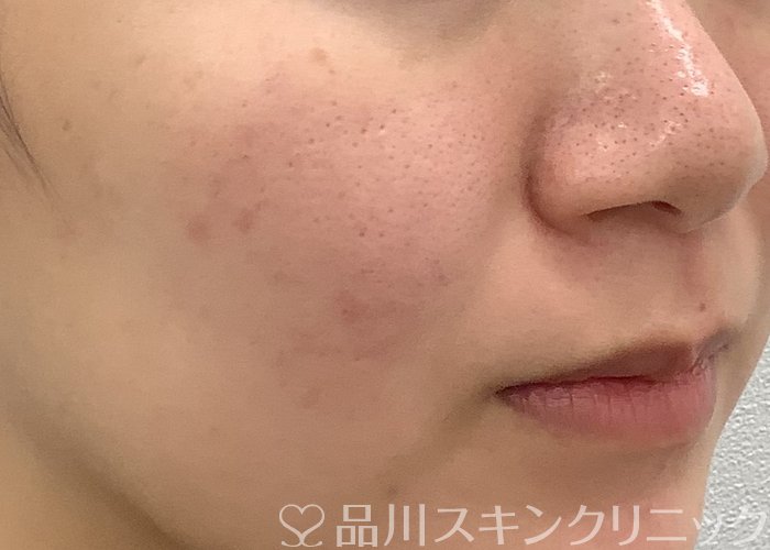 症例NO.69530のBEFORE写真